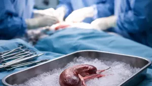 Rekordot döntött a veseátültetések száma Magyarországon